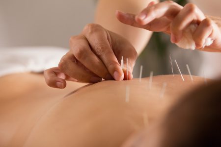 How Acupuncture Can Alleviate Back Pain