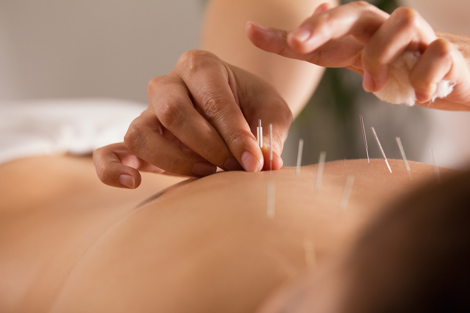 How Acupuncture Can Alleviate Back Pain