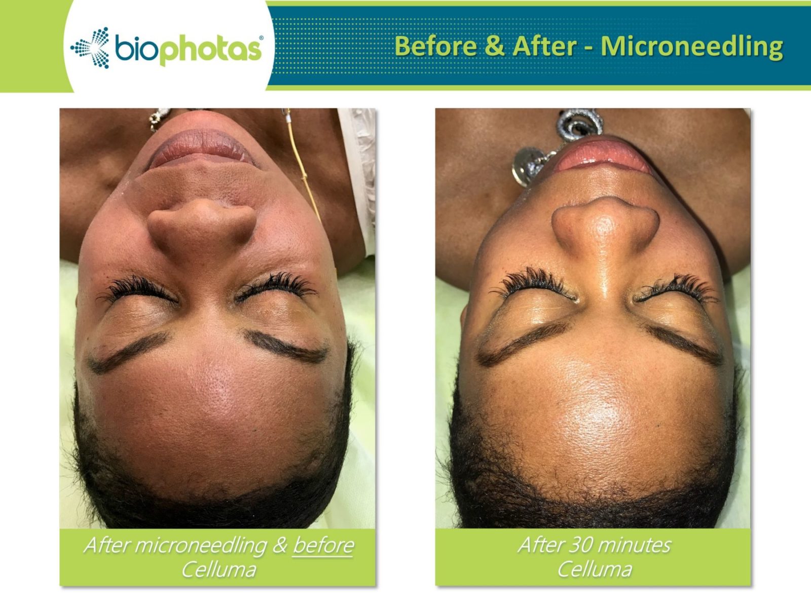 Celluma Light Therapy in Reading, Berkshire Karolina Acupuncture