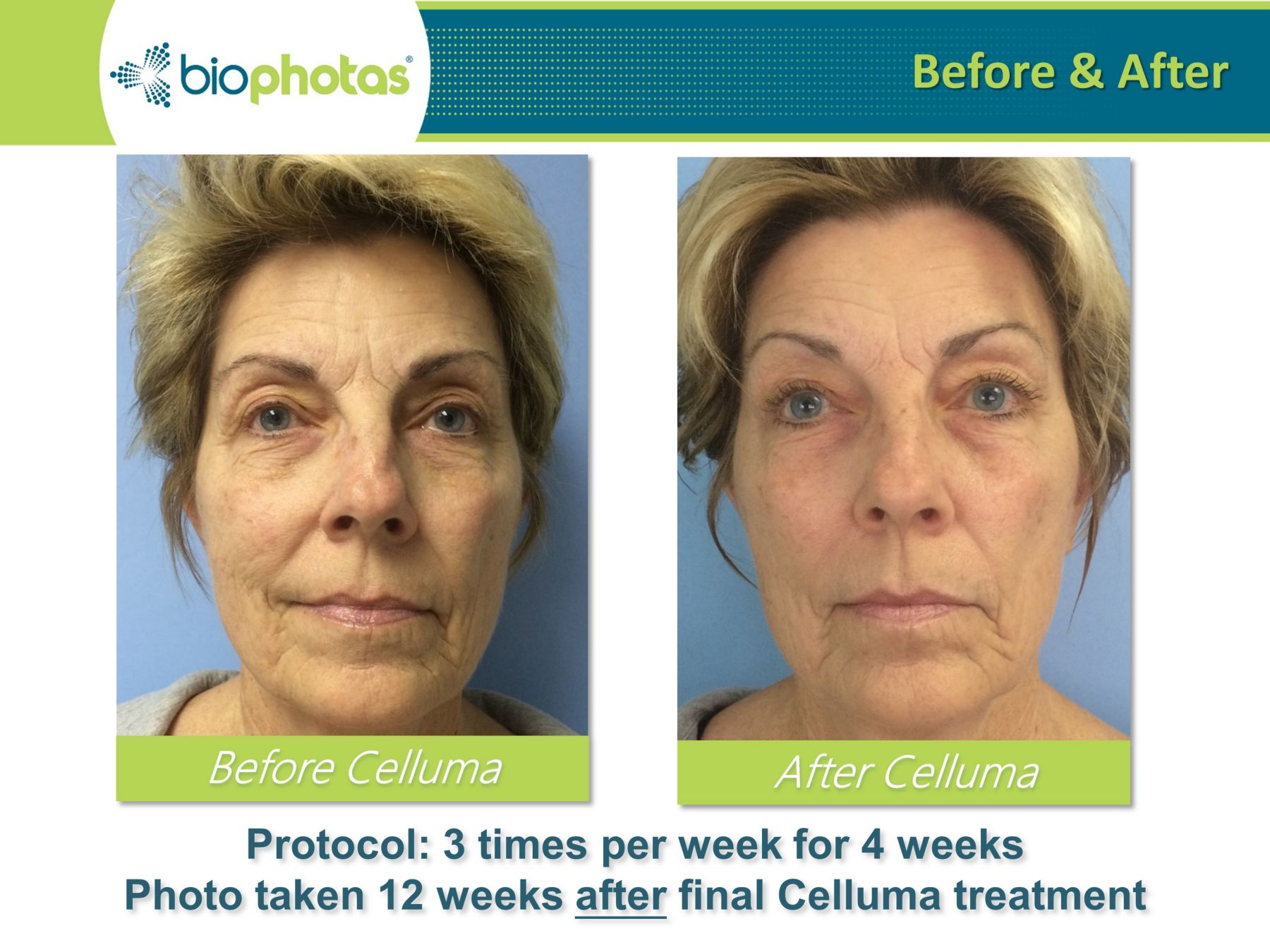 celluma light therapy before and after