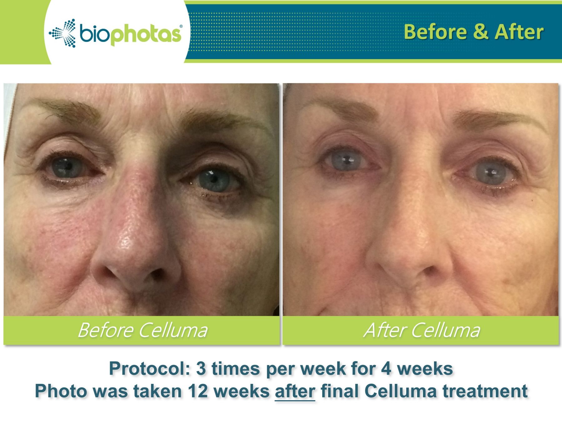 celluma light therapy before and after