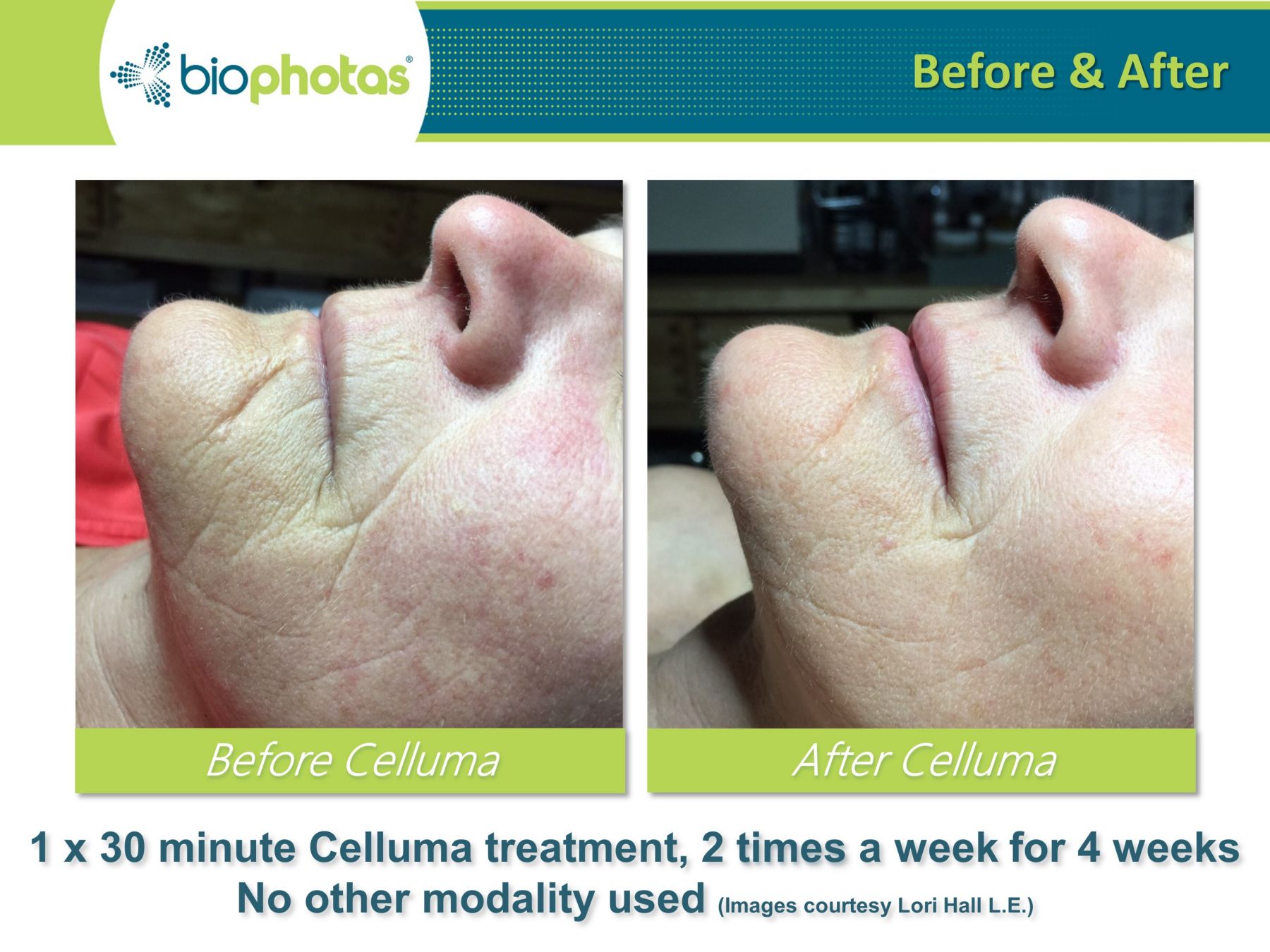 celluma light therapy before and after