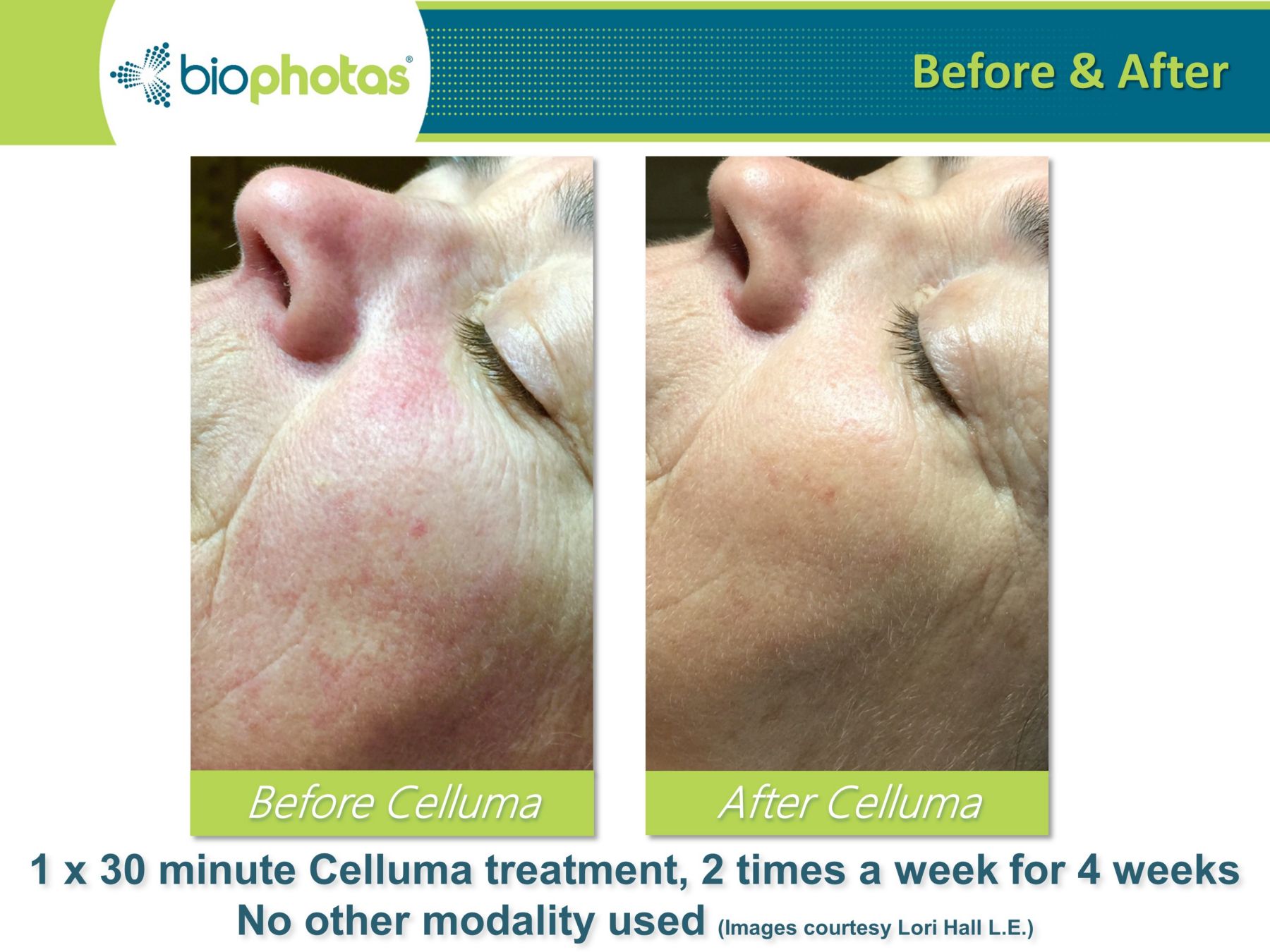 celluma light therapy before and after