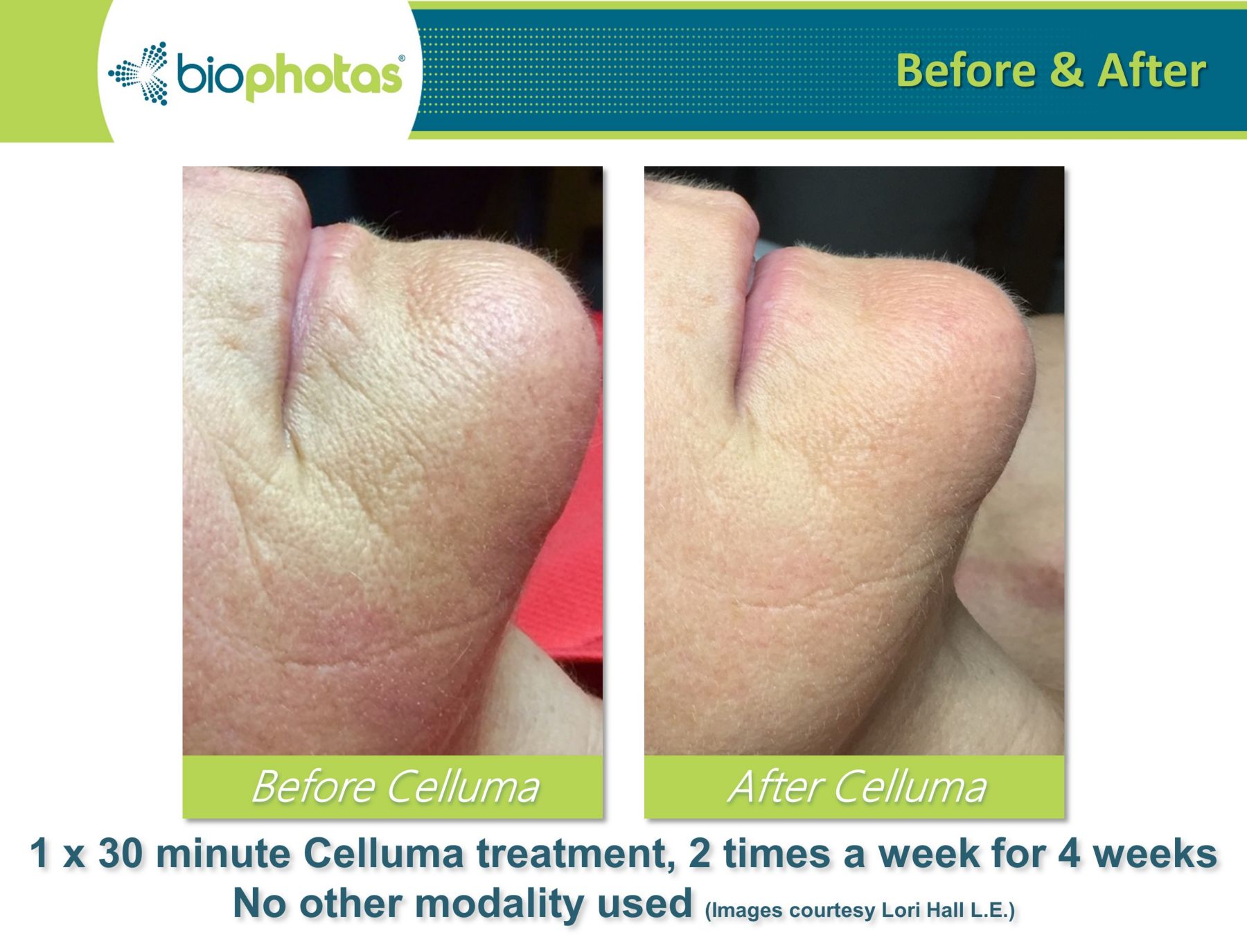 celluma light therapy before and after