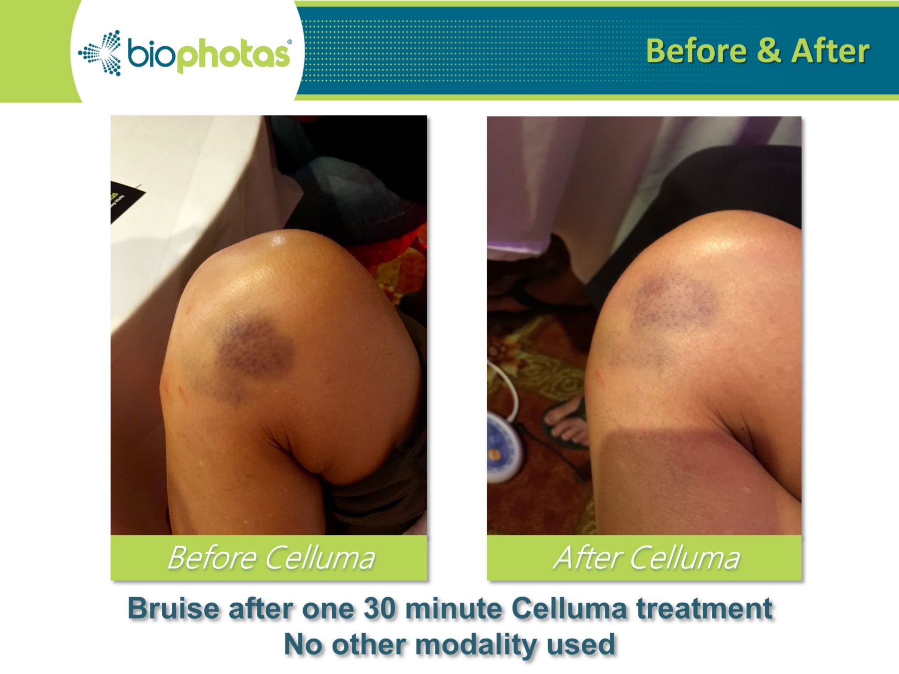 celluma light therapy before and after