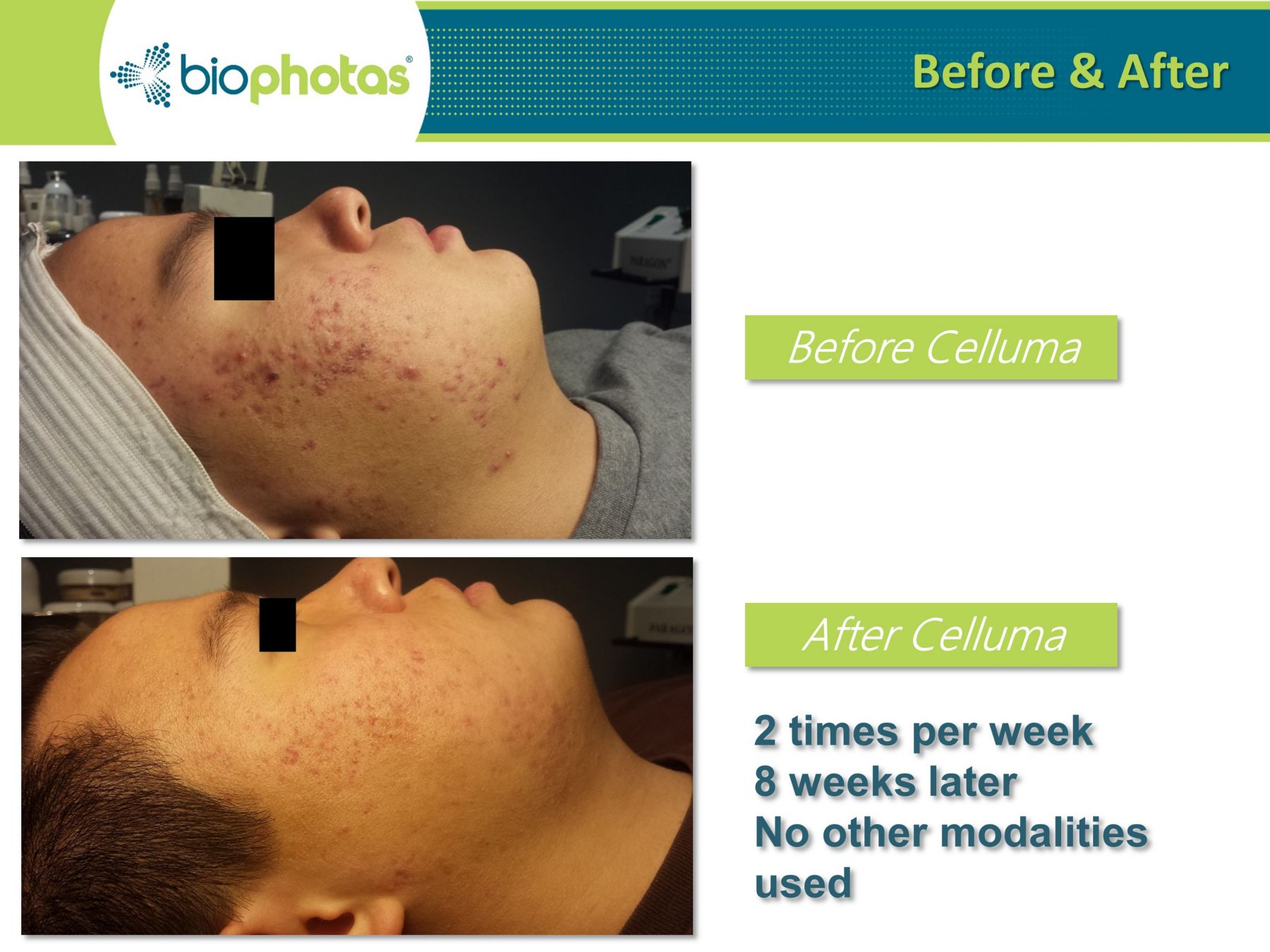 celluma light therapy before and after