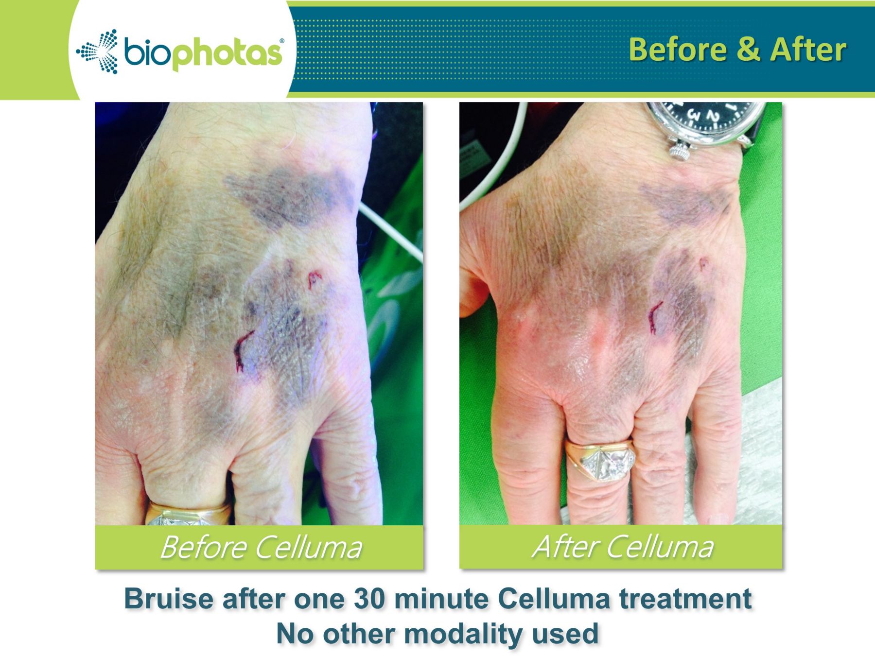 celluma light therapy before and after