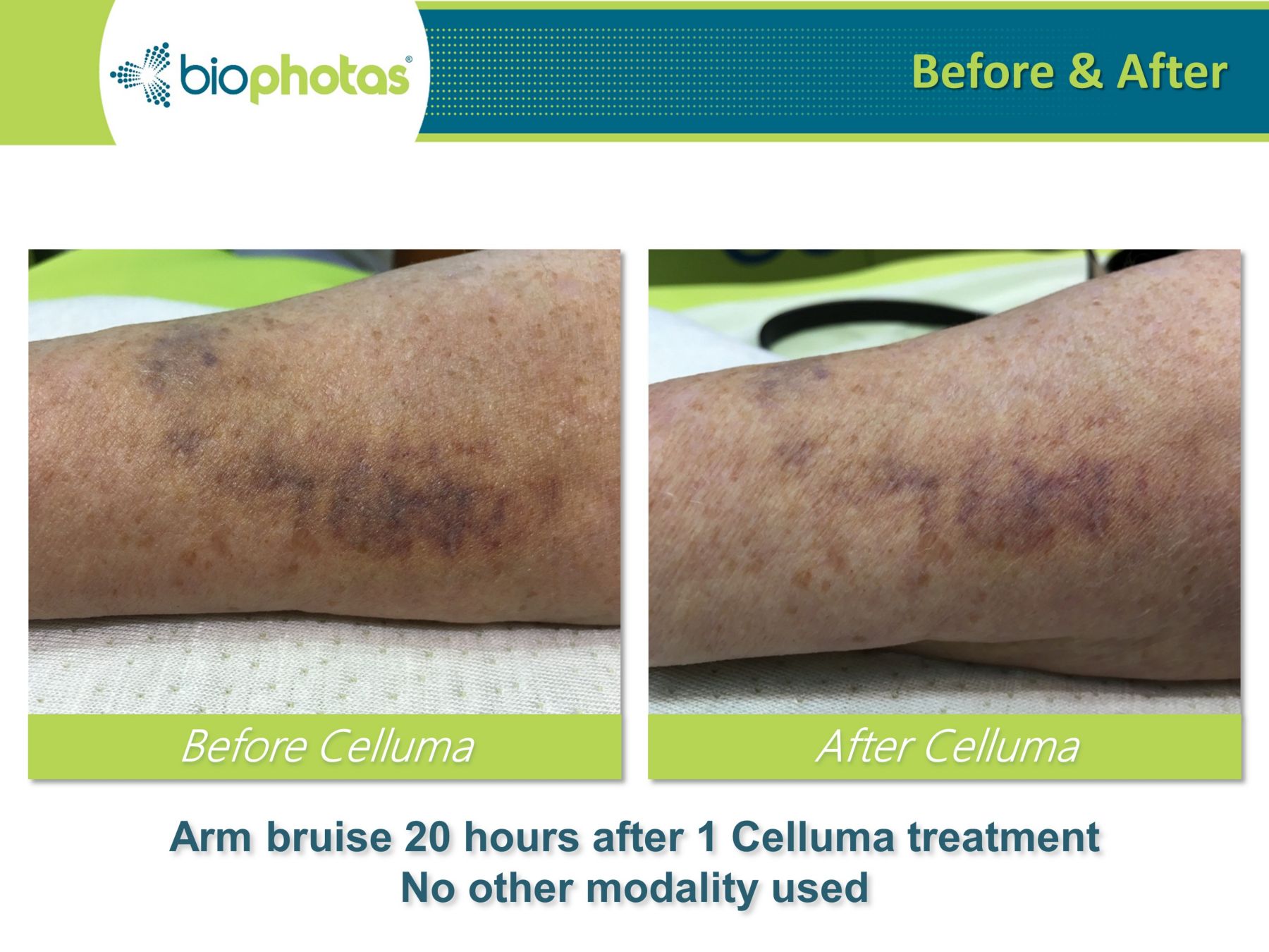celluma light therapy before and after