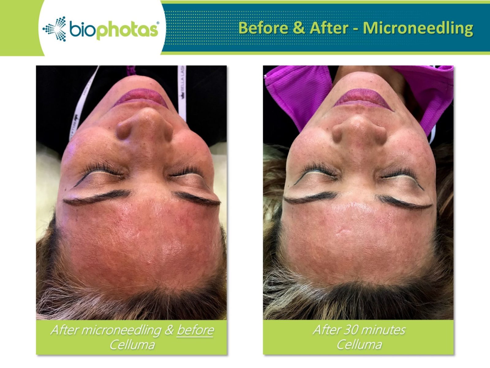 Celluma Light Therapy in Reading, Berkshire Karolina Acupuncture