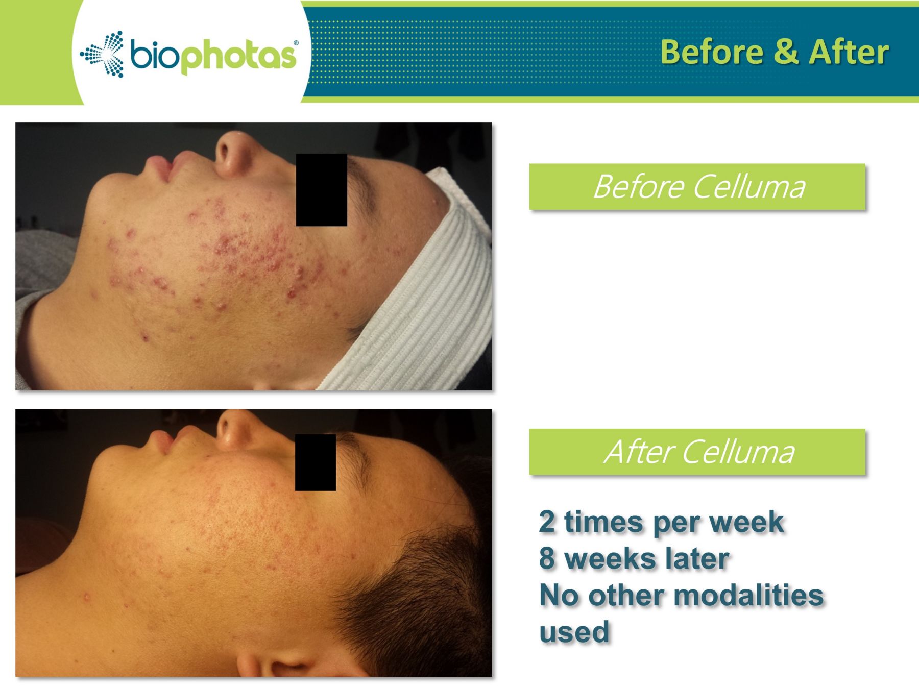 celluma light therapy before and after