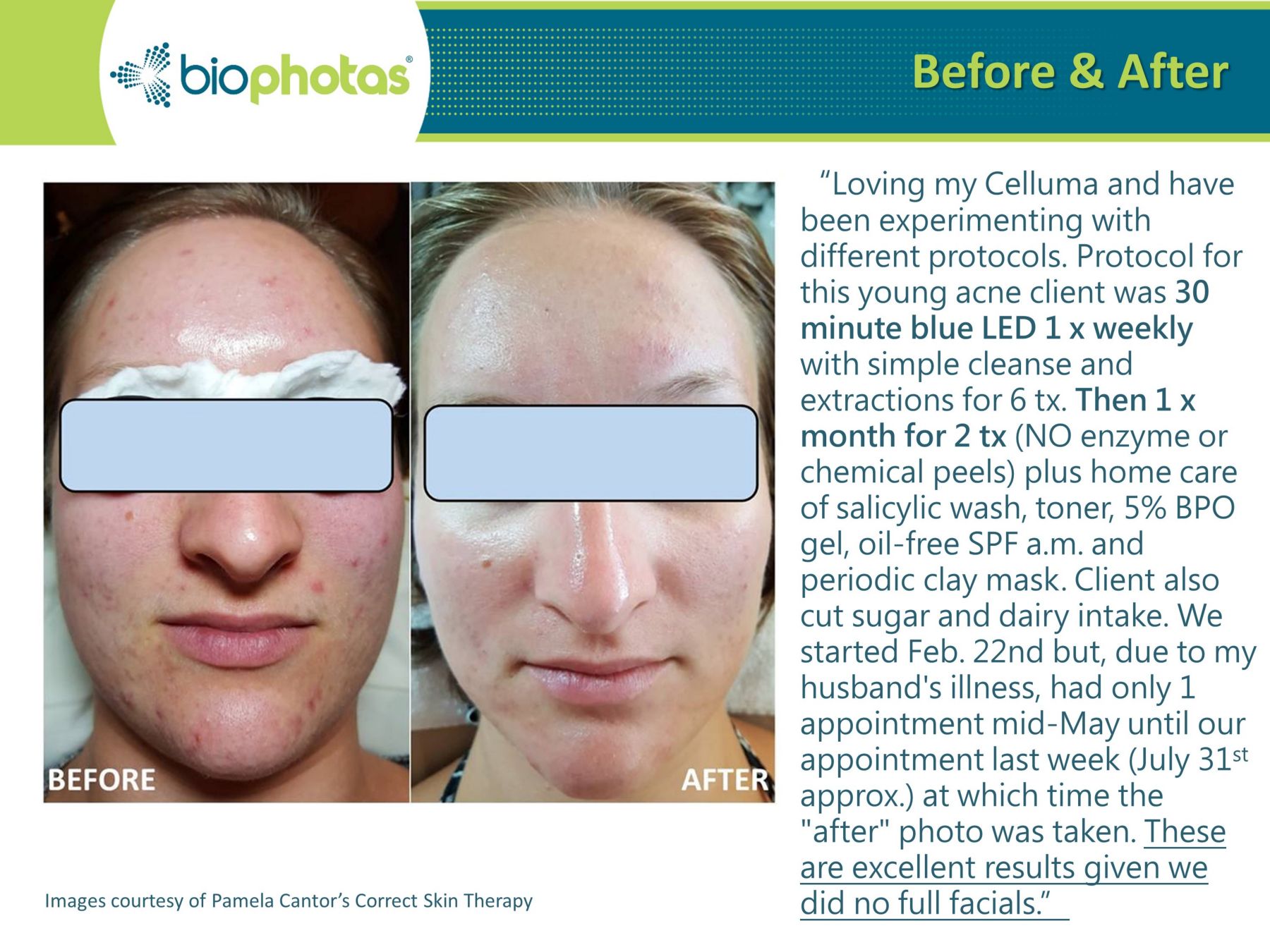 celluma light therapy before and after