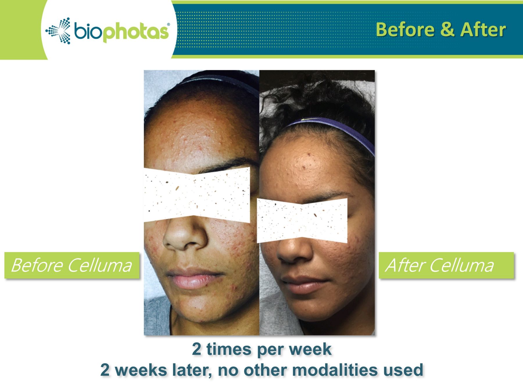 celluma light therapy before and after