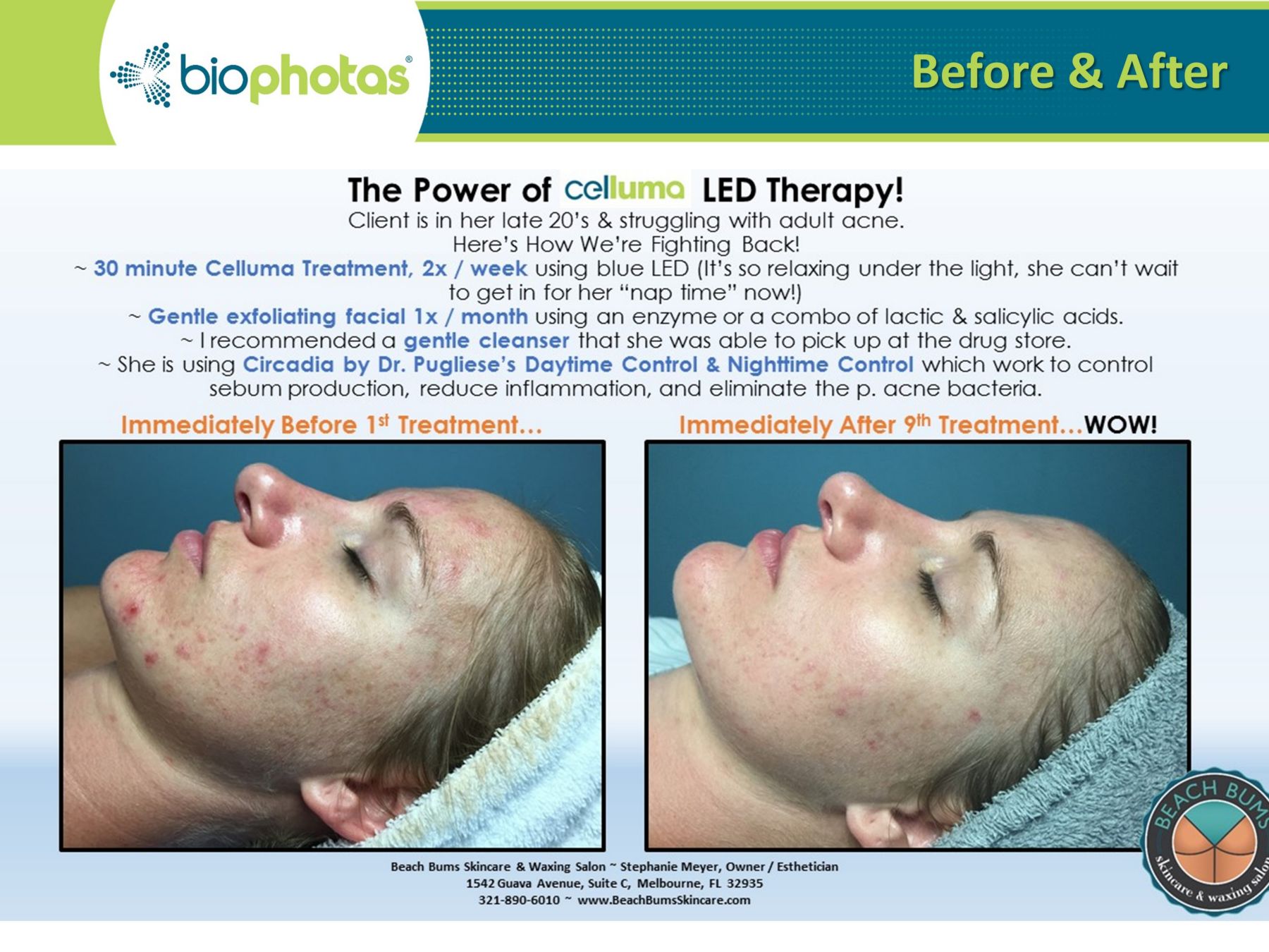 celluma light therapy before and after