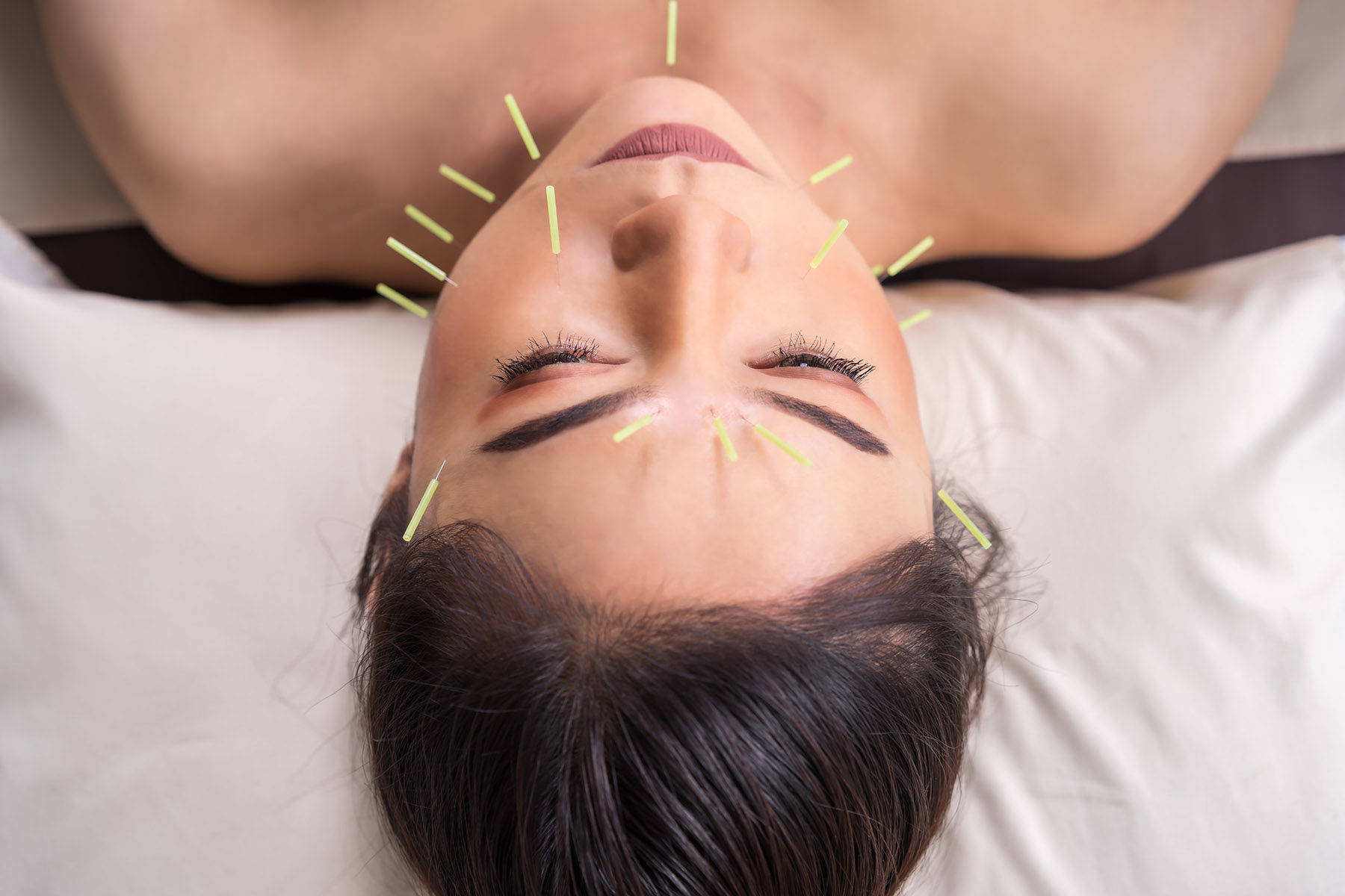 cosmetic acupuncture in reading